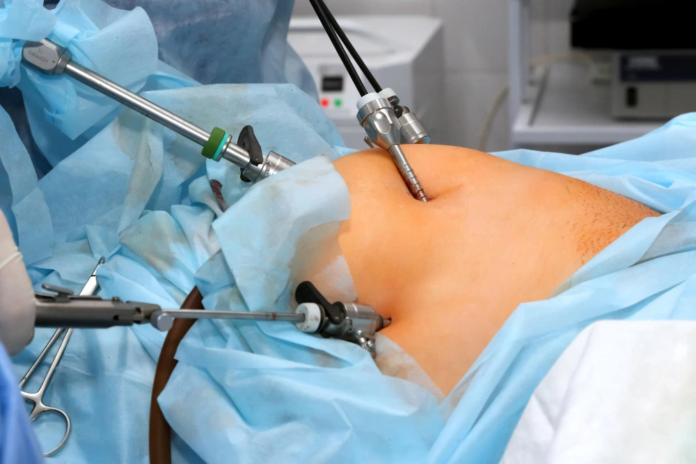 Henia Laparoscopic Surgery
