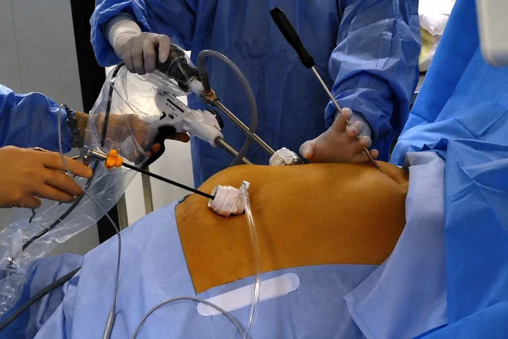 Laparoscopic Varicocelectomy
