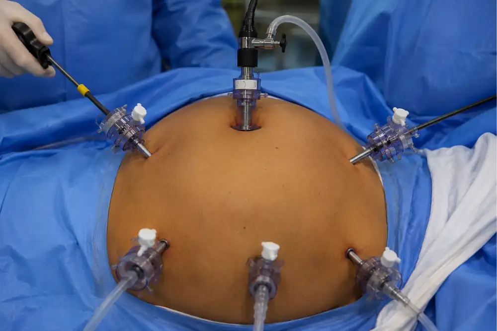 Rectal_Prolapse_Surgery_25kb